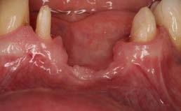 mandibular alveolar ridge augmentation.