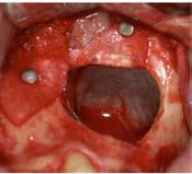 Horizontal and Vertical Defects Complications of Mandibular Alveolar Ridge