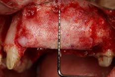 protocols to address the various horizontal and vertical alveolar ridge defects that