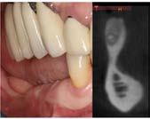 It will include the use of titanium mesh particulate grafting protocols