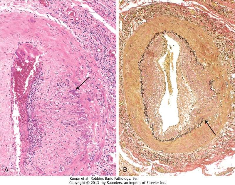 ) Giant Cell (Temporal) Arteritis morphology