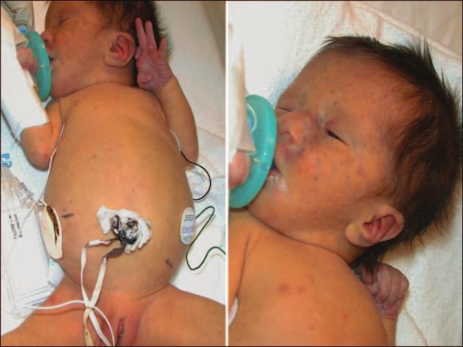 Figure 4. Newborn who has hepatosplenomegaly, jaundice, purpura, and petechiae due to congenital CMV infection.