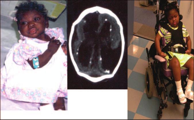Figure 5. A 14-day-old infant who has congenital CMV infection and exhibits microcephaly (left), ventriculomegaly, encephalomalacia, and periventricular calcifications (center) by computed tomography.