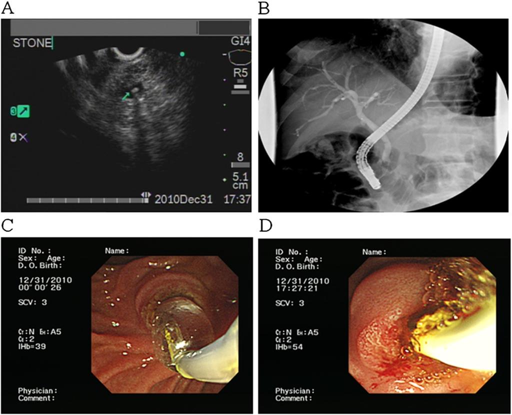Chan et al. BMC Gastroenterology 2013, 13:44 Page 4 of 6 Figure 2 (A) A tiny CBD stone is revealed using linear EUS. (B) However, no definite filling defect is seen in the ERCP picture.