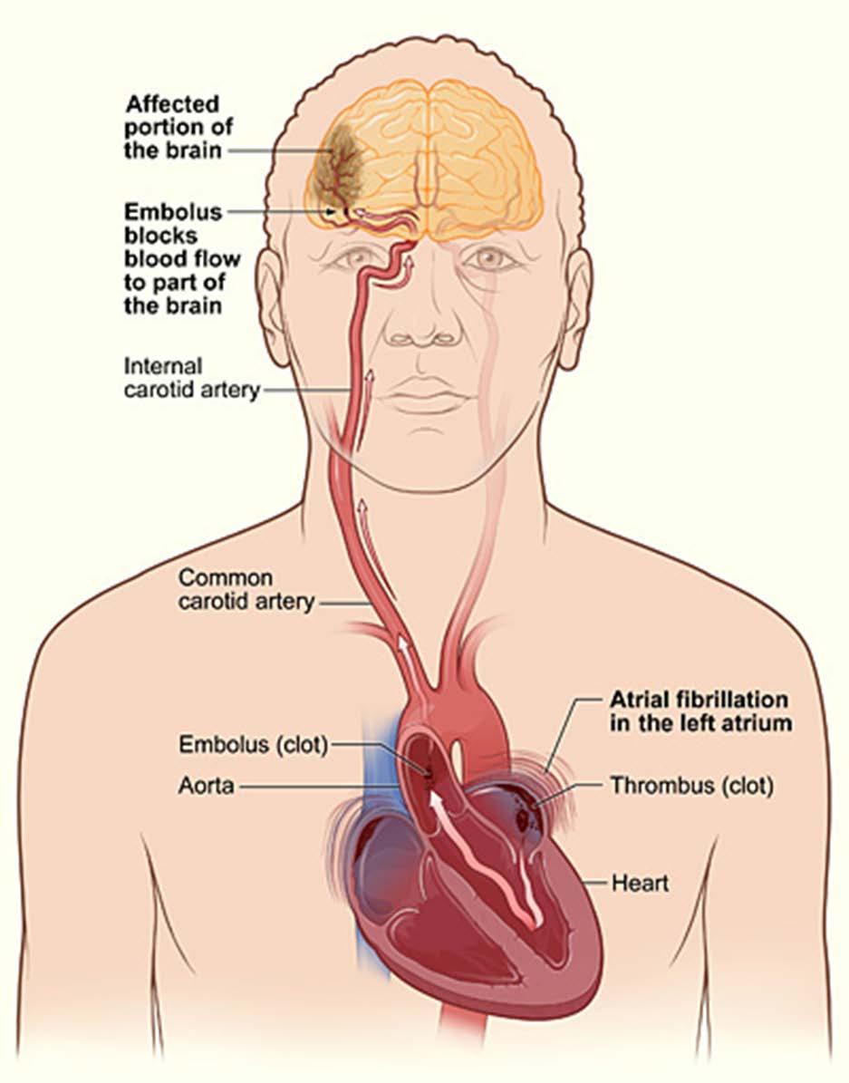 ACUTE ISCHEMIC STROKE Risk factors Prior TIA or stroke DM Family history of atherosclerosis CAD PAD aka PVD Atrial fibrillation CHF Dilated