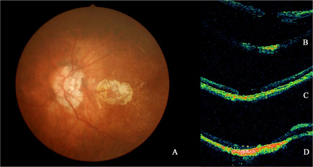 Hong et al. BMC Ophthalmology (2015) 15:165 Page 5 of 7 Fig. 2 Fundus photograph and OCT images (a, b, c and d) from Patient 20. a PCA around MH was shown on fundus photograph.