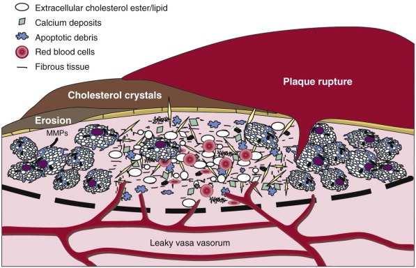 Vascular Inflammation: A New Horizon in Cardiovascular Risk Assessment 105 appropriate genetic and environmental triggers, the modified lipoproteins release inflammatory signals to activate