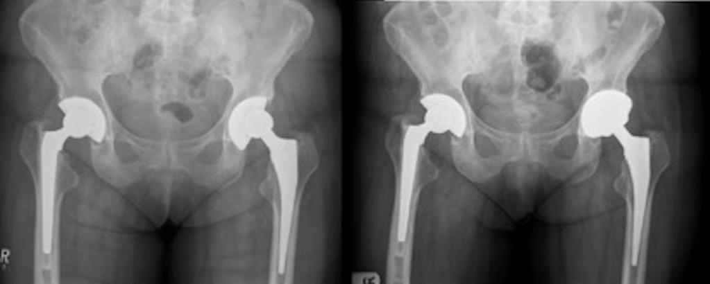 )503( Figure 1. Patient 1 pre and post revision surgery x-rays. Figure 2. Patient 2 pre and post revision surgery x-rays. underwent revision of their acetabular components only.