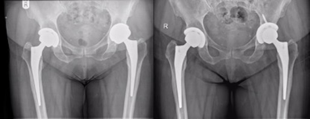 Mean time to revision was 63 months (range 1-118 months) for the six patients who underwent revision. However two of these patients did not have their femoral component revised.