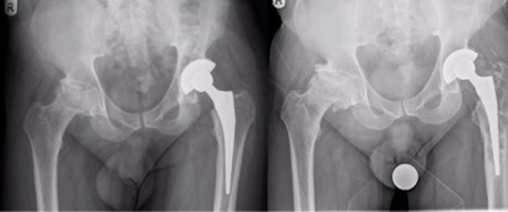 Patient underwent revision of right total hip replacement to a ceramic-on-polyethylene bearing and stem size changed from Size 9 to 15 and had an uneventful course since revision surgery [Figure 3].