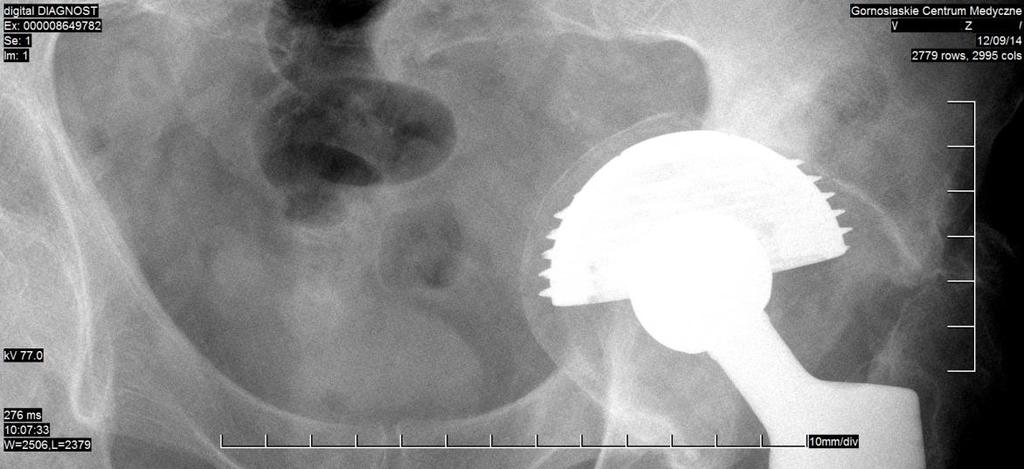 of acetabular cups coated with hydroxyapatite.
