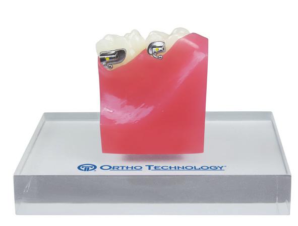 Base with 80 Gauge Indented esh Pad provides an anatomically correct fit that conforms to the tooth ensuring maximum bond strength The Indented Pad assists in easy and accurate placement to conform