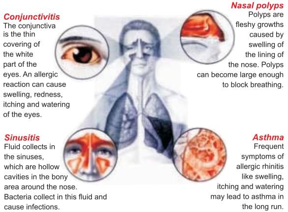 All that is bad enough, but also, if allergic rhinitis is not treated properly, there can be other problems, some of them more serious, like: What Is The Treatment For Allergic Rhinitis?