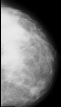 DOES BREAST DENSITY PLAY A FACTOR IN DETERMINING SCREENING RECOMMENDATIONS?