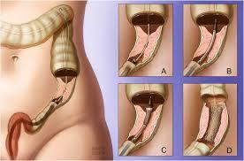 resected without the need of a colostomy Stent placement provides an