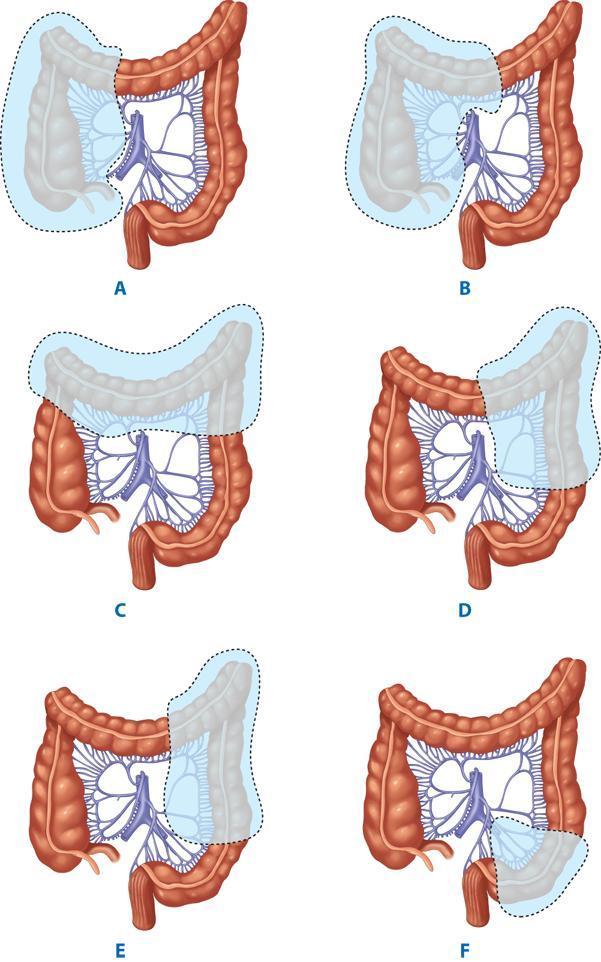 Segmental colon resection En bloc resection for negative radial margin Complete mesenteric lymph node resection High ligation of mesenteric pedicle Minimum 13 lymph nodes in specimen