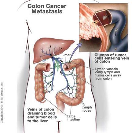 HOW DOES COLON CANCER METASTASIZE?