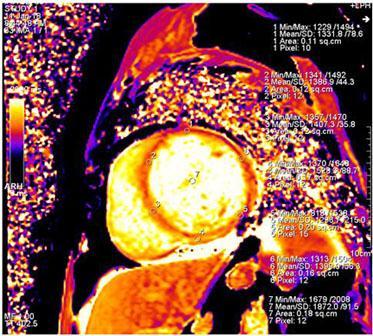 segments. Figure (7): Color coded map representing the elevated native T1 values in the scarred myocardial segments in a patient of HCM.