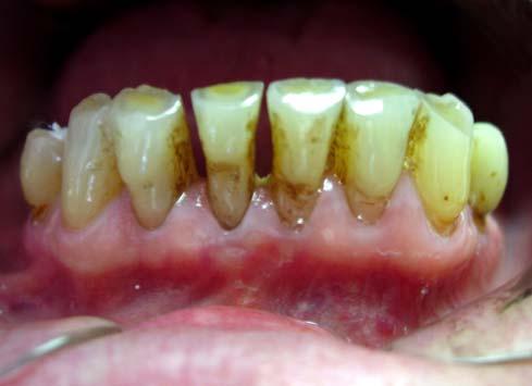 D. Mladenović et al. colors of artificial crown and natural tooth on the photograph as more even as possible (13).