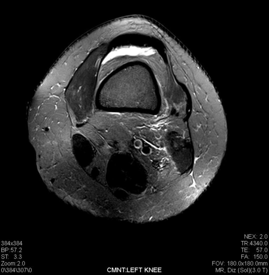Fig. 2: Isolated SPFP impingement Radiology, Acibadem University