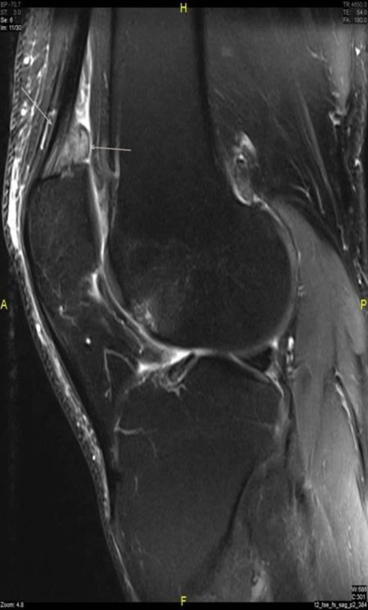 Fig. 3: T2 FS-sagittal image grade IV chondromalacia with SPFP edema.