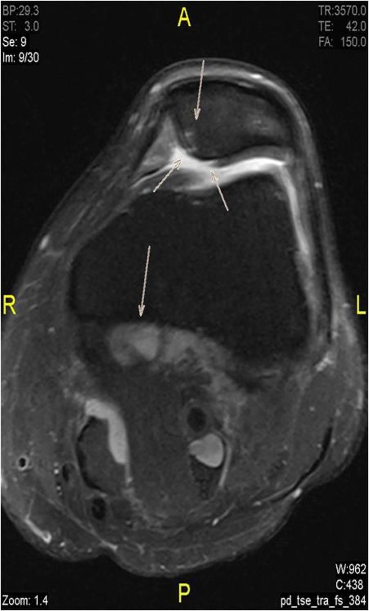 Images for this section: Fig. 7: pd-fs-aksiyal image, Hoffa edema and Baker cyst with SPFP edema.