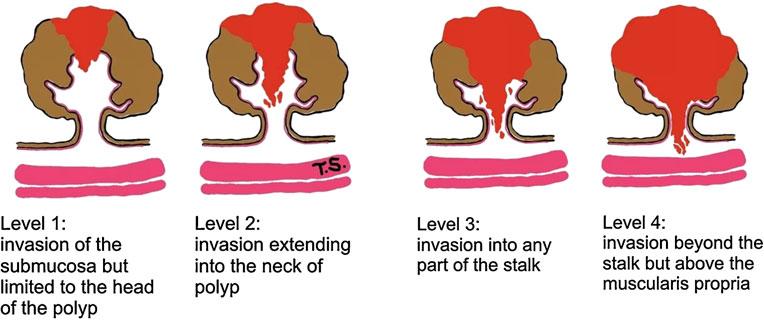 10 Virchows Arch (2011) 458:1 19 Fig. 1 Kikuchi levels of submucosal infiltration modified from Ref.
