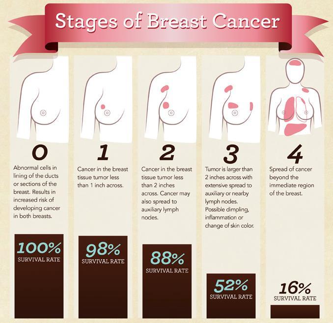 BREAST CANCER Breast cancer is the most common cancer in American women. About 1 in 8 women will develop some form of breast cancer in their lifetime.