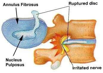 Prolapsed intervertebral disc (slipped disc) This is a frequently used diagnosis with a