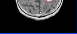 brain mets - Typical radiation schedule: 30 Gy/10 fr 37.