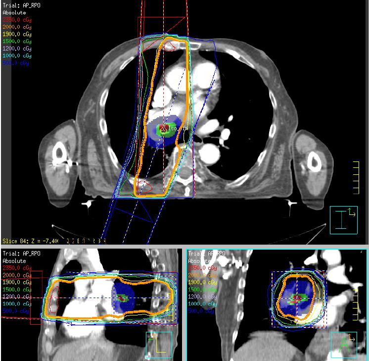 82 year old male with T1N0M0 SCC of the Right Bronchus (Stage 1A) planned to receive definitive radiation with a
