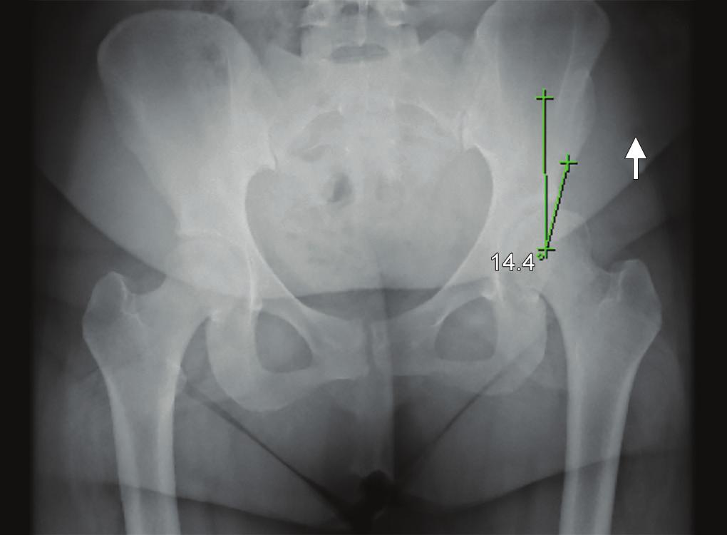 Concomitant Hip Arthroscopy and Periacetabular Osteotomy Fig. 1: A preoperative weight-bearing anteroposterior radiograph demonstrating a LCEA measuring 14.