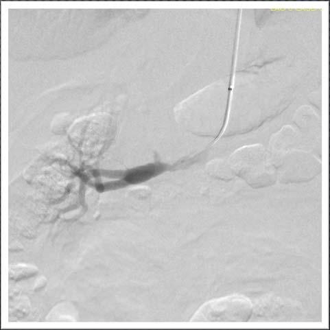 CO2 ANGIOGRAPHY W/PTA BASED ON VAS LAB FINDINGS RIGHT RENAL ARTERY STENOSIS OF ABOUT 80%