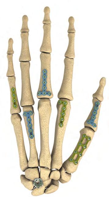 reconstruction of bones, including the scapula, olecranon, humerus, radius, ulna, pelvis, distal tibia, fibula, hand and foot in