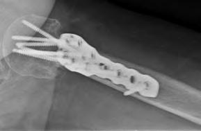 The Flower Proximal Humerus Plate accepts both variable angle locking and non-locking screws.