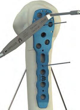 A minimum of two k-wires are required to stabilize the fracture before applying the plate. c.