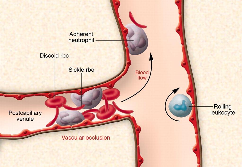 Red Cell and White Cell Adhesion Underlies Sickle Cell VOC Frenette, P. S. et al. J.