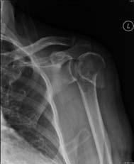 DISPLACED FRACTURES INVOLVING SURGICAL NECK RCT from UK 2, 3, and 4 part fractures No difference between