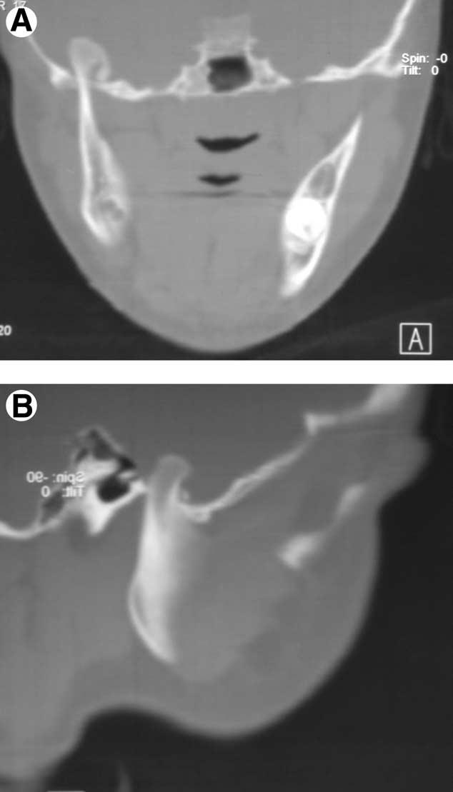CILLO, SINN, AND ELLIS 861 FIGURE 3. Coronal (A) and sagittal (B) computed tomography showing displacement of the mandibular condyle into the middle cranial fossa.