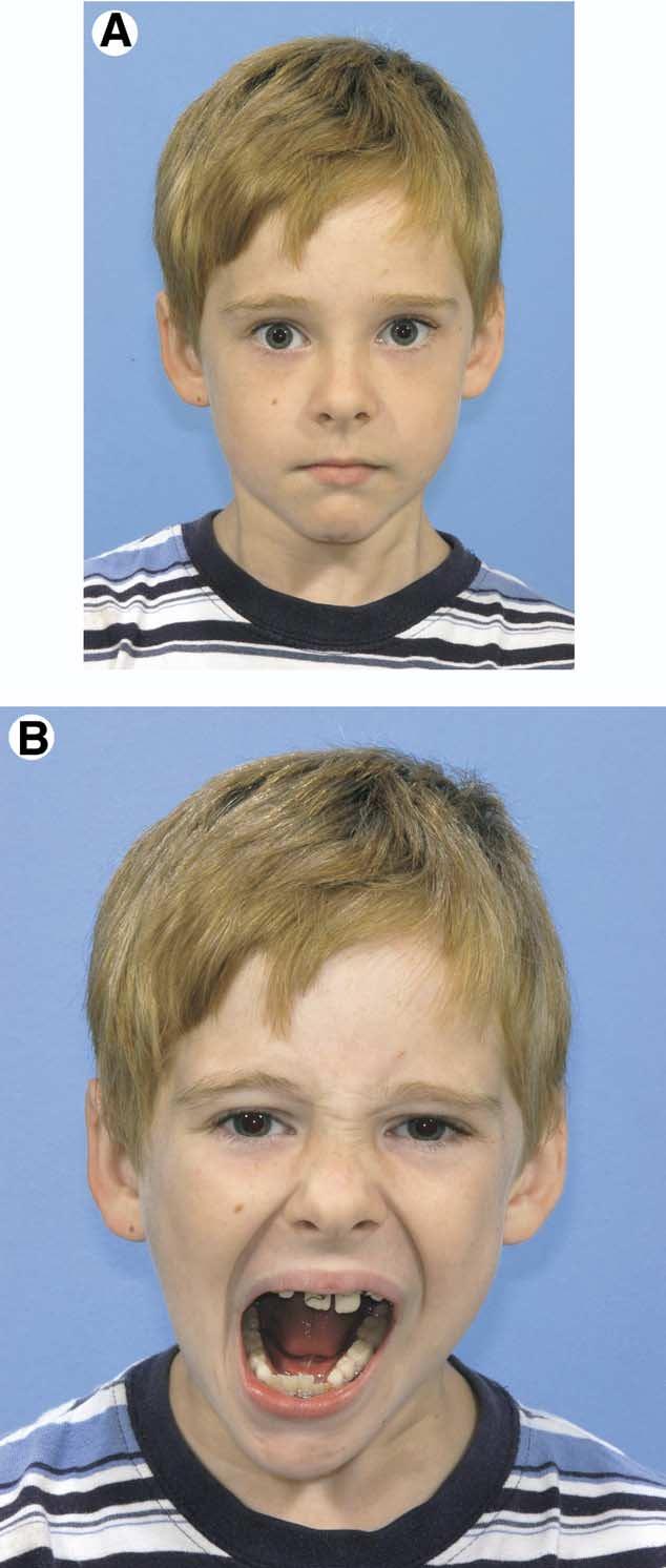 In conclusion, superior dislocation of the mandibular condyle into the middle cranial fossa is a rare event that predominately occurs in children because of the anatomic composition of the mandibular