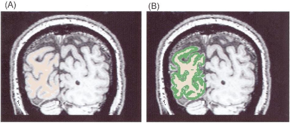 Figure 5 The semiautomatic selection of gray matter from magnetic resonance images.
