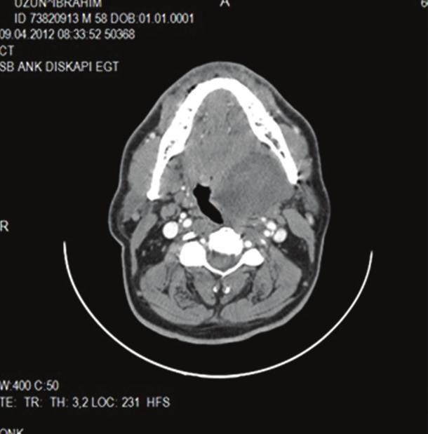 2 Case Reports in Otolaryngology Figure 1: Preoperative CT scan and MRI demonstrate a hyperintense mass. Figure 2: Intraoperative and gross feature of the mass.