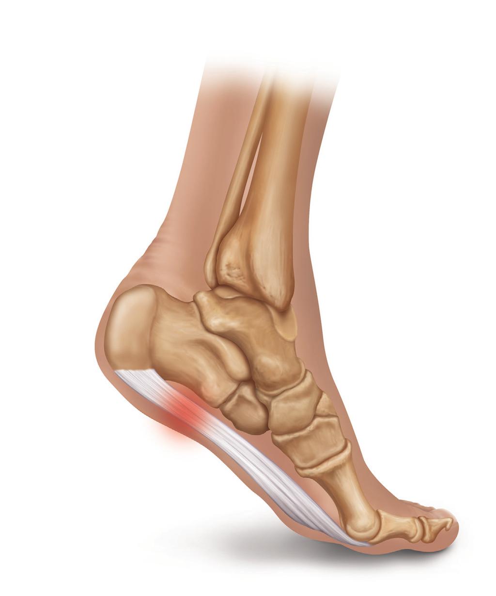Plantar fasciitis is the most common cause of heel pain for which professional care is sought.
