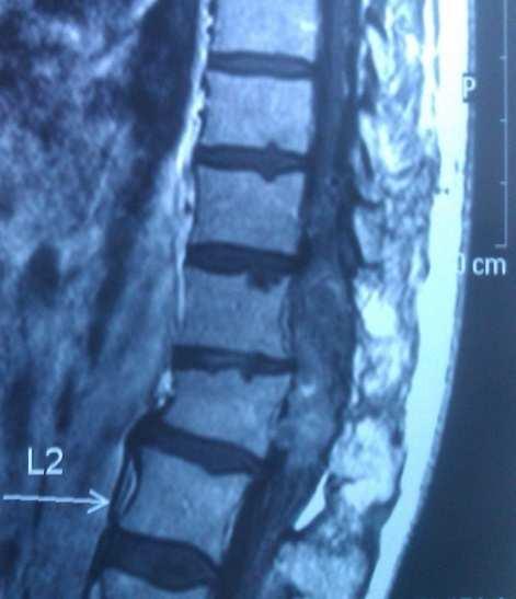 Romanian Neurosurgery (2014) XXI 4: 442 447 443 type II spinal AVM s, glomus type lesions or angioma racemosum arteriovenosum.