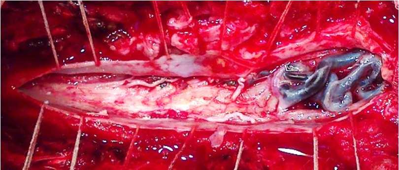 Romanian Neurosurgery (2014) XXI 4: 442 447 445 Figure 3 C after resection of the superior portion of the nidus Figure 3 D the dissector is pointing to the