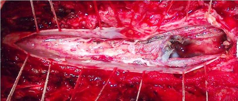From the vascular rearrangement standpoint the fate of any spinal AVM is either thrombosis or bleeding secondarily to proteolitic wall dissection.