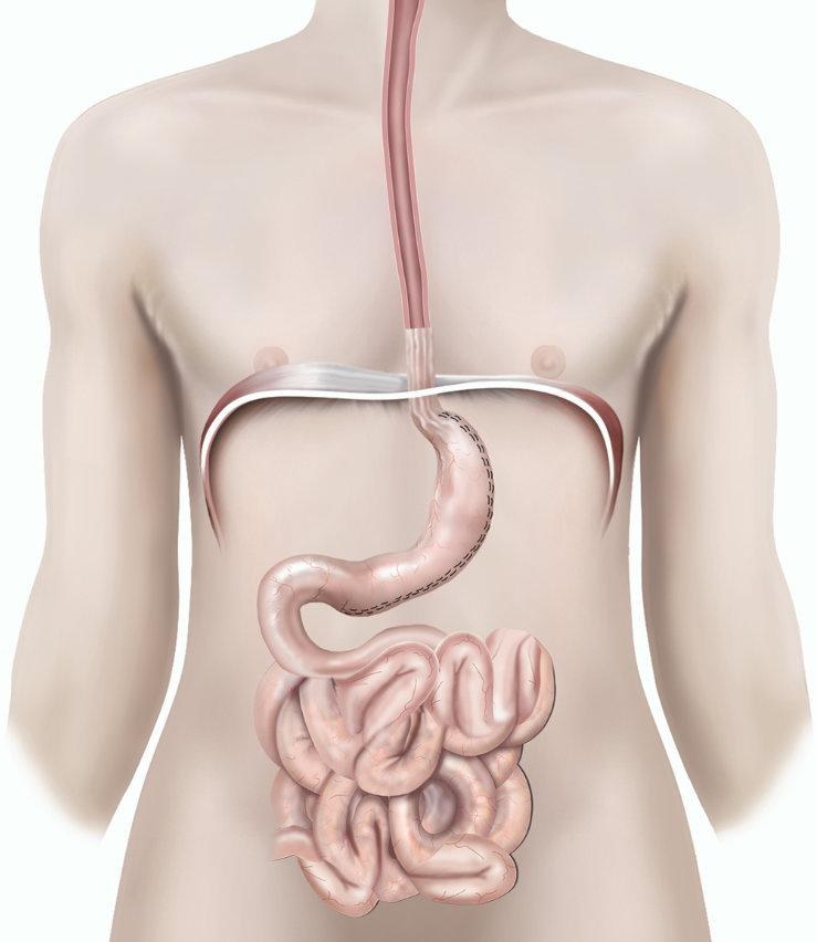What is a sleeve gastrectomy? A sleeve gastrectomy involves reducing the size of your stomach to a short tube shape (see figure 1). It works by making you feel full sooner so that you eat less.
