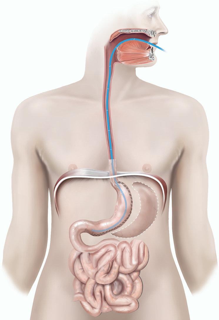 Your surgeon will remove the excess stomach and the bougie. They may use stitches to reinforce the staple line and may test for leaks using dye injected down a small tube.