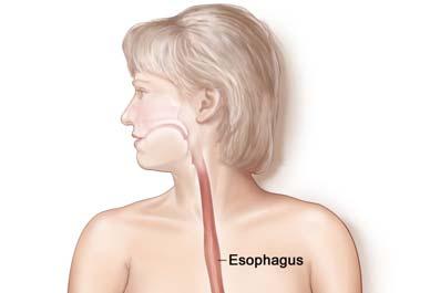 DISTANT METASTASIS The most common sites for primary esophageal cancers are: Liver Lungs Pleura The most common sites for primary gastric cancers are: Liver Peritoneal surface Distant lymph nodes