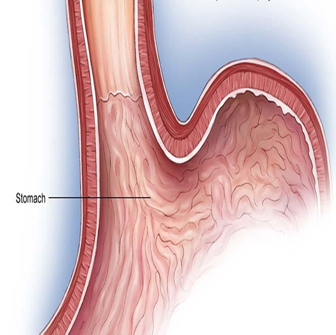 Code Description AJCC Disease ID 0 NO involvement of esophagus or gastroesophageal junction AND epicenter at ANY DISTANCE into the proximal stomach (including distance unknown) 17: Stomach 2